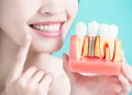 What to Know Before Choosing Dental Implants in Vietnam