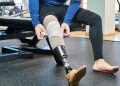 How Can an Attorney Help After Traumatic Limb Loss?
